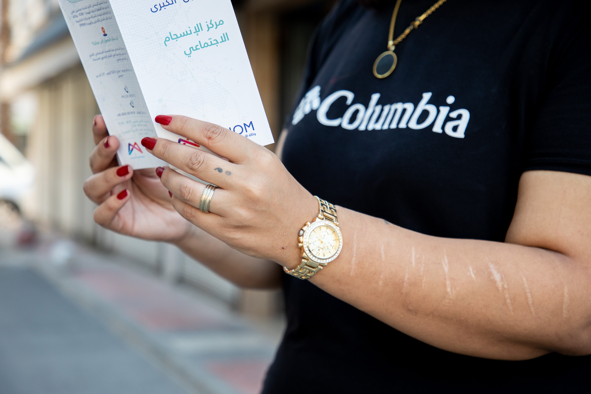 A woman holds a brochure with a series of scars appearing on her arms